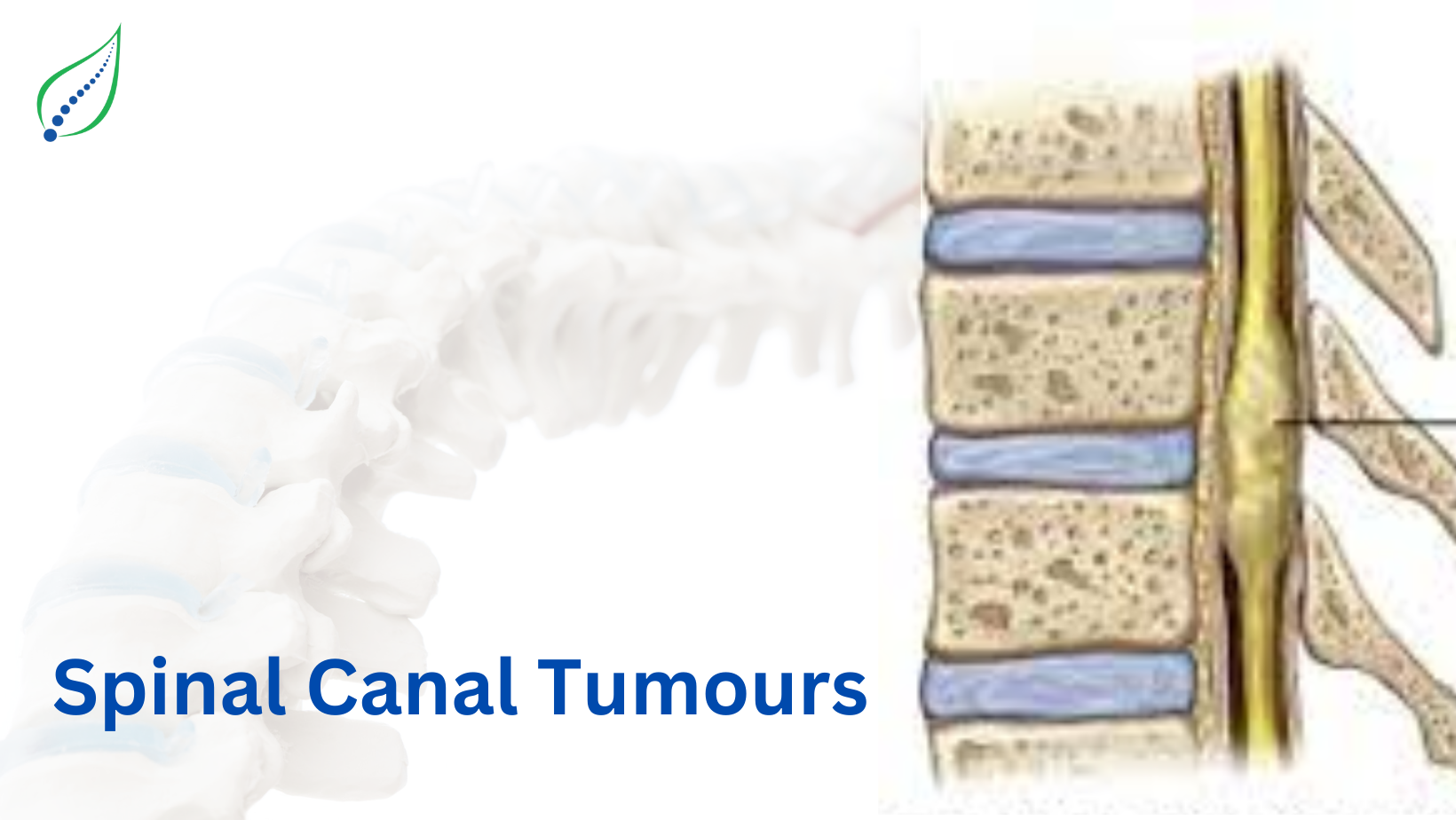 Spinal Canal Tumour